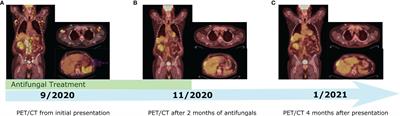 Case Report: New Onset Lymphadenopathy After Immune Checkpoint Inhibitor Therapy Presents a Clinicopathological and Radiological Challenge